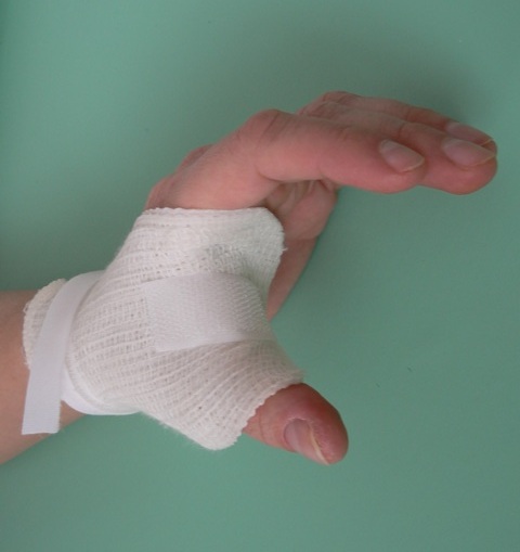Rehabilitace ruky-dlahování3